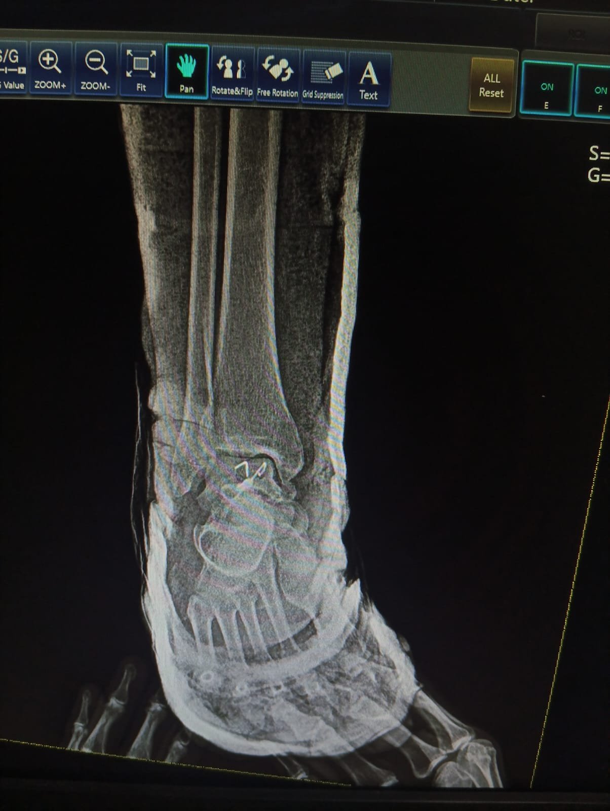 Post-op imaging